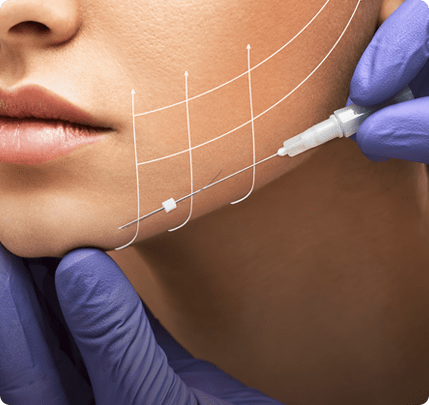 PLLA Thread Lift Training Toronto